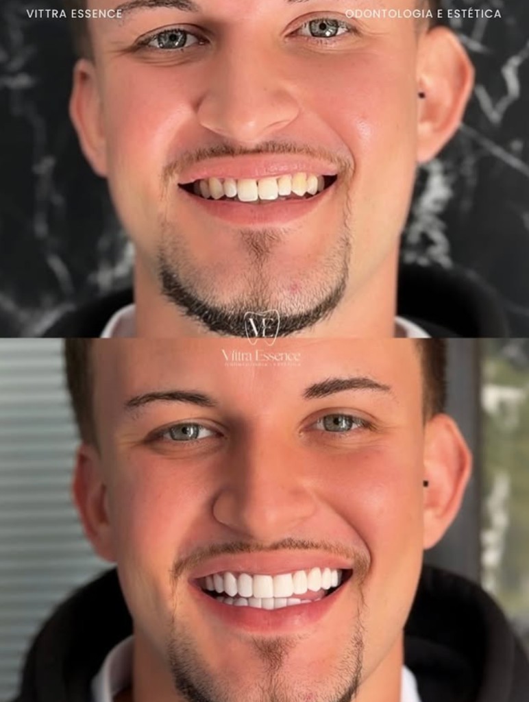 Antes e depois