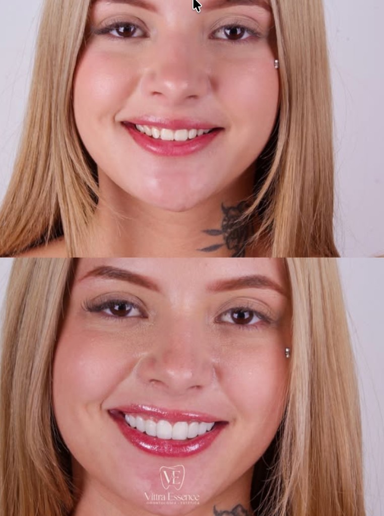 Transformação do sorriso