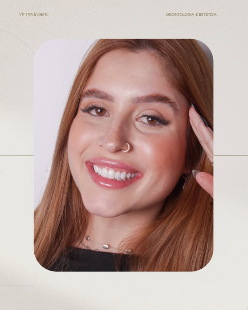 Resultado de sorriso Vittra Essence